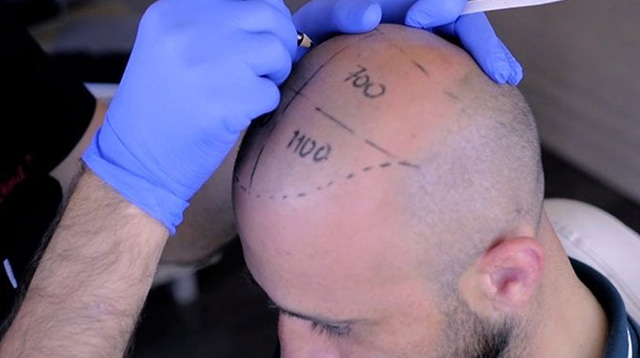 Saç Ekiminde Greft Hesaplaması