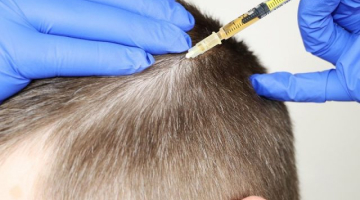 PRP ile Saç Tedavisi